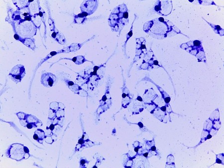IDENTIFICADA EM PACIENTE COM LEISHMANIOSE CUTÂNEA CEPA RESISTENTE AO FÁRMACO MAIS UTILIZADO NO PAÍS