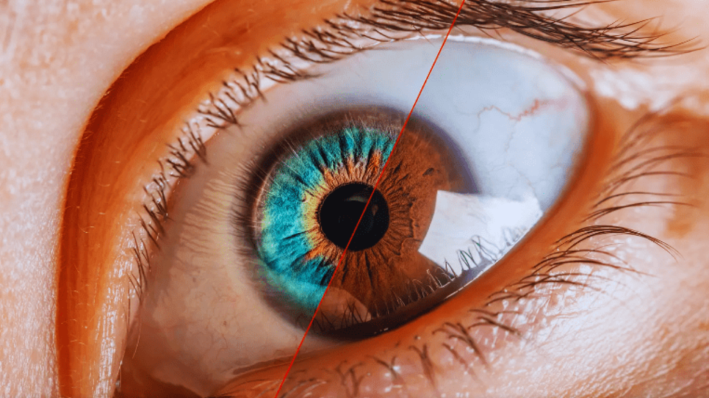 Cirurgia para mudar a cor dos olhos: os riscos por trás da estética